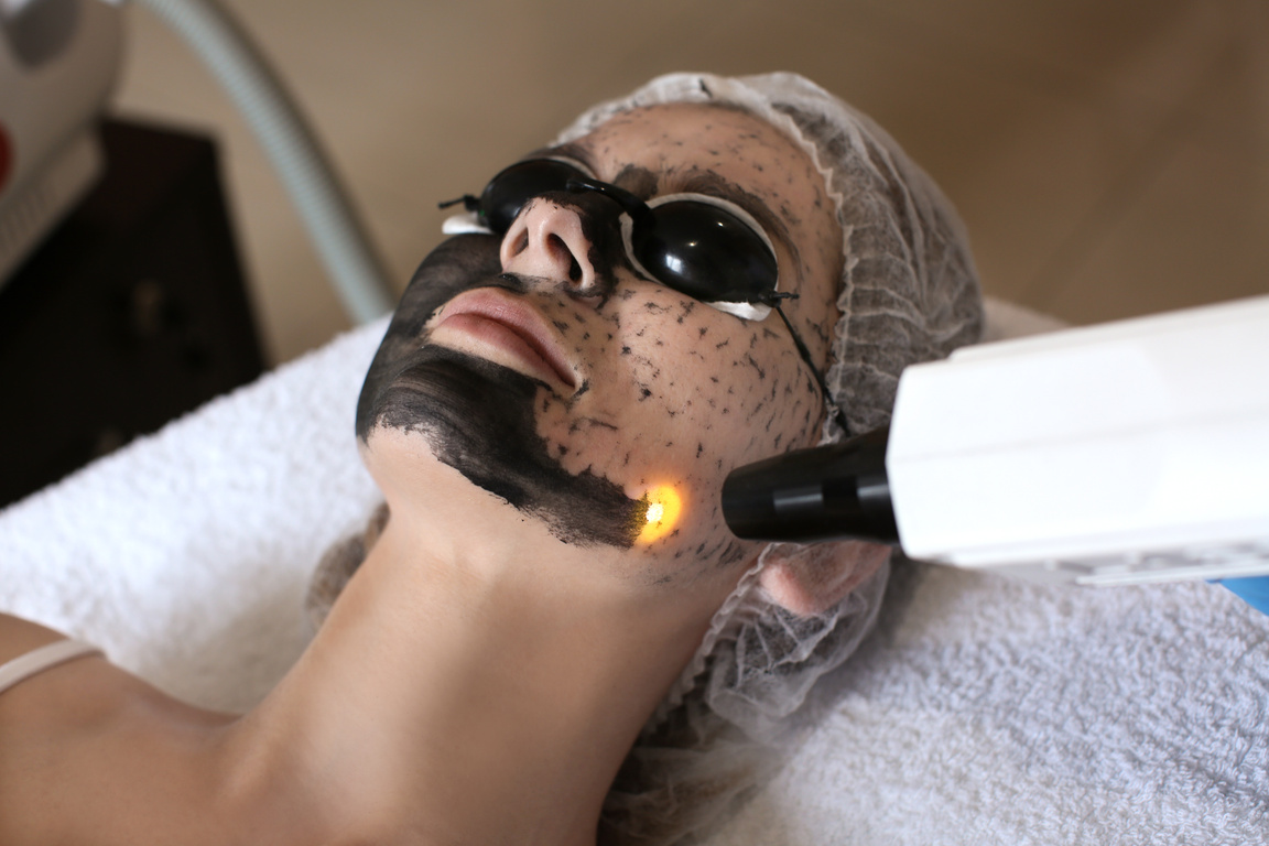 Young Woman Undergoing Carbon Peeling Procedure in a Salon